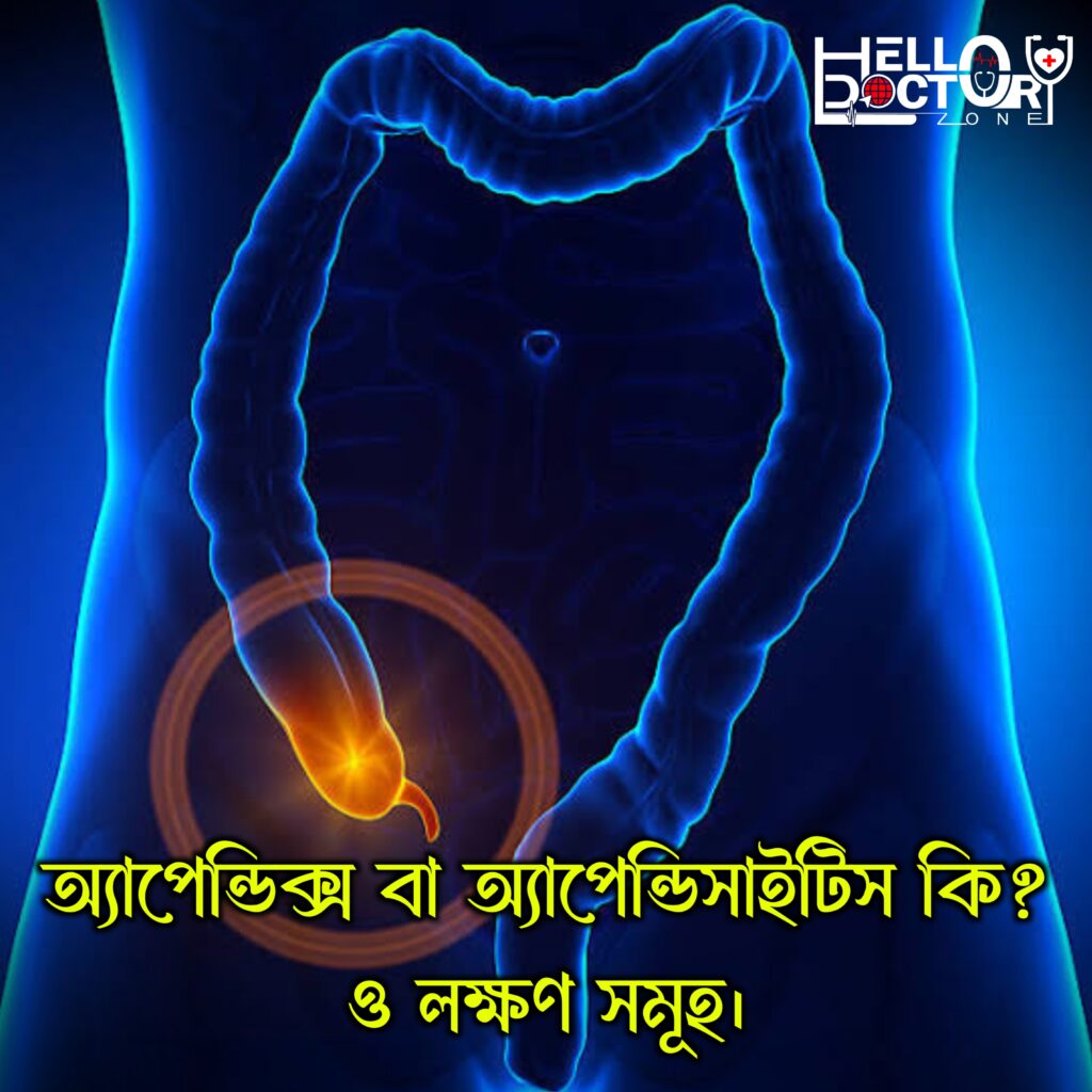 অ্যাপেন্ডিক্স বা অ্যাপেন্ডিসাইটিস কি, লক্ষণ ও চিকিৎসা