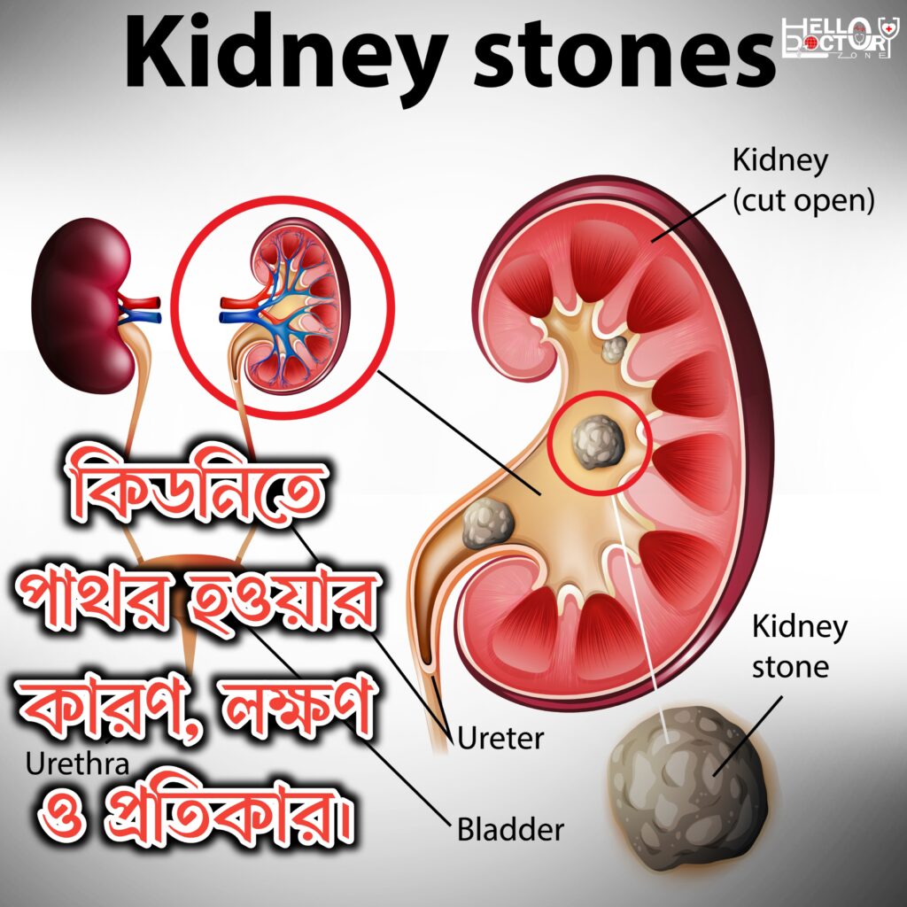কিডনিতে পাথর হওয়ার কারণ, লক্ষণ ও প্রতিকার