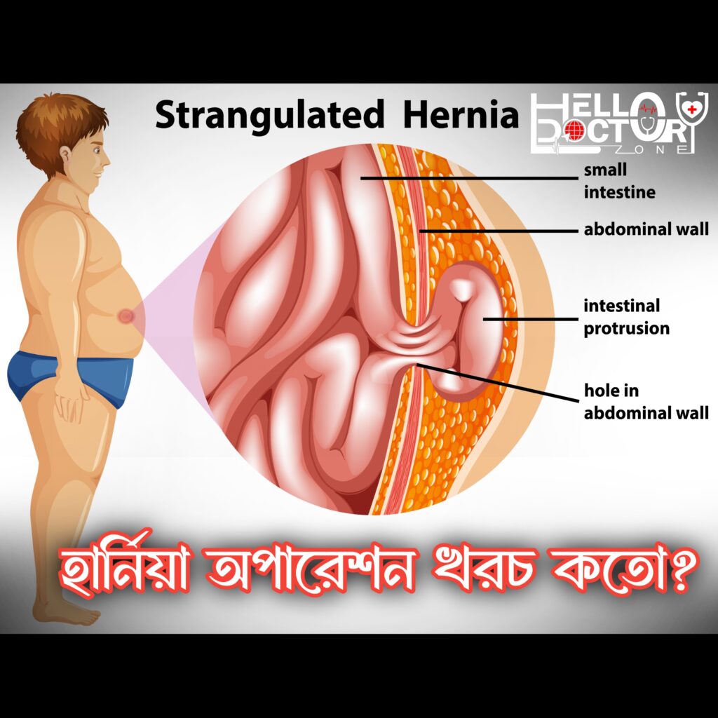 ঢাকায় হার্নিয়া অপারেশন খরচ কত